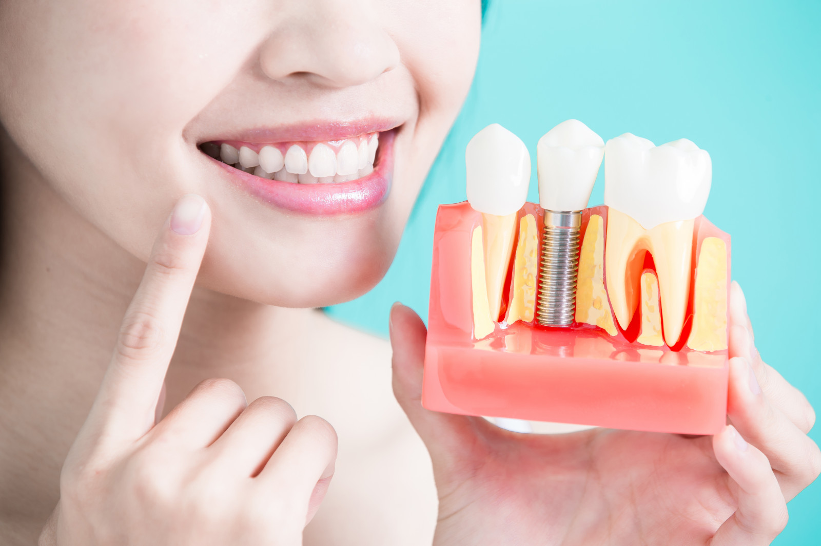 dental implant in karaikudi