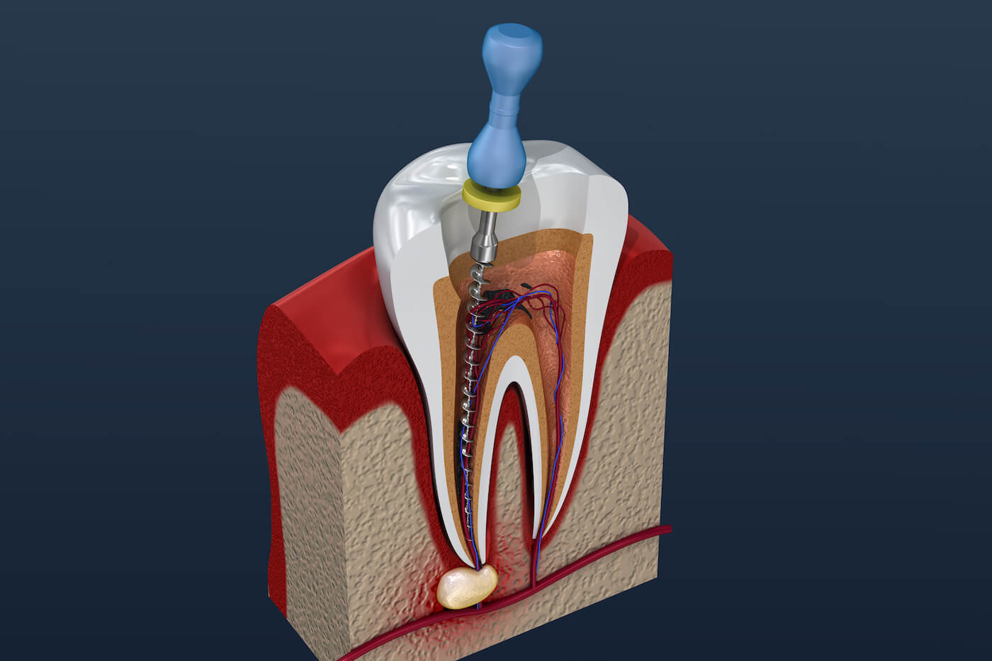 root canal treatment near me Image
